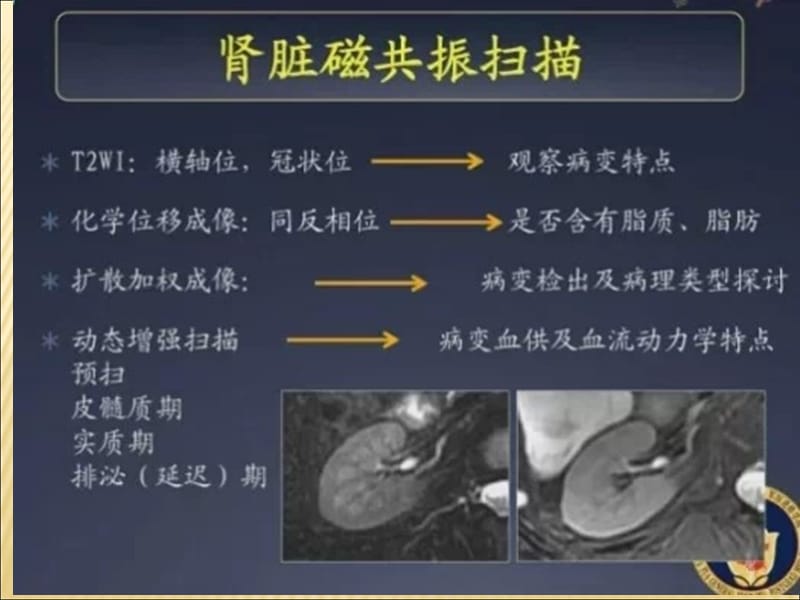 肾细胞癌MRI诊断及鉴别诊断.ppt_第3页