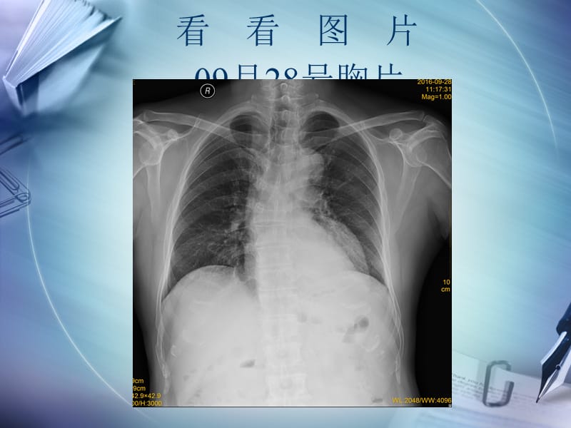 肺脓肿病例讨论(模板).ppt_第3页