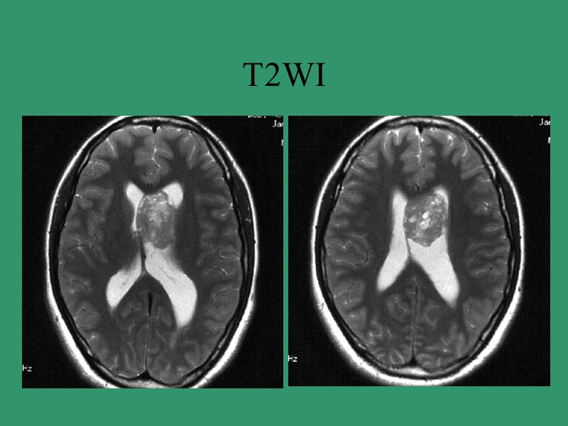 脑室内肿瘤鉴别诊断.pptx_第3页