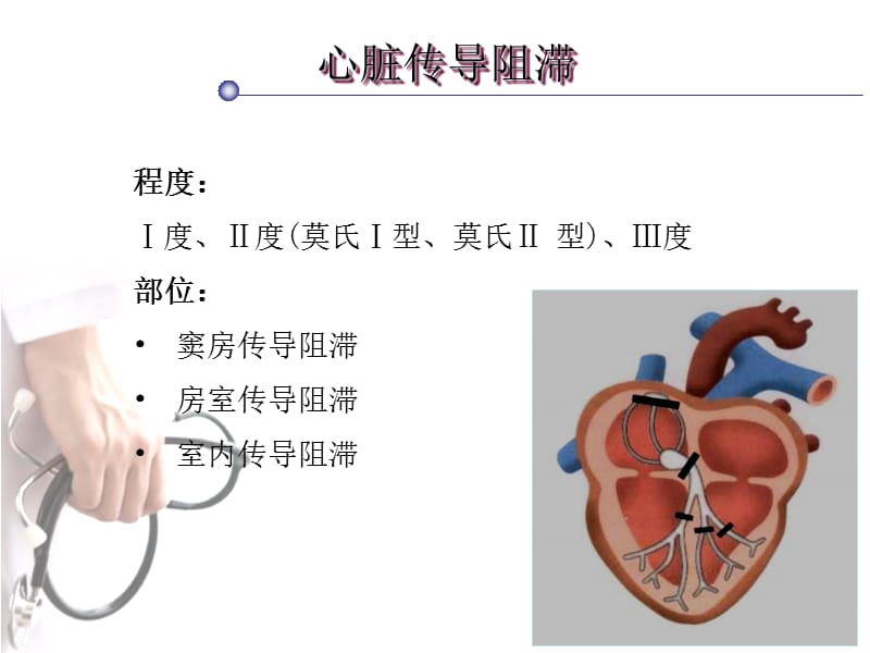 心脏传导阻滞.ppt_第2页