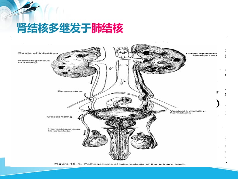 泌尿及男生殖系结核病人的护理.ppt_第3页