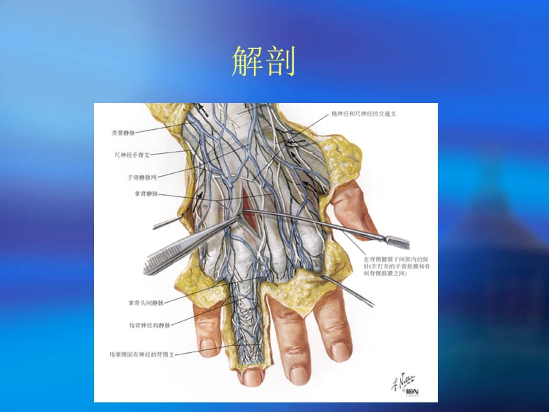 第五掌骨颈骨折.pptx_第2页