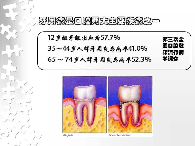 牙周病的修复治疗.ppt_第2页