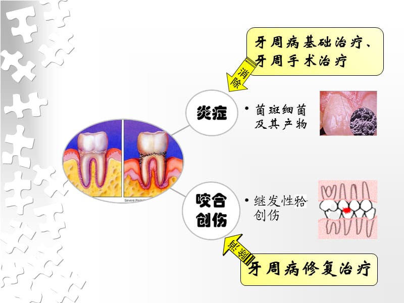 牙周病的修复治疗.ppt_第3页