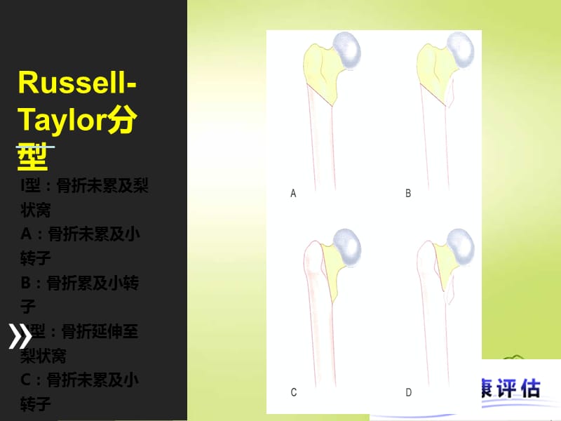 股骨粗隆下骨折.pptx_第2页