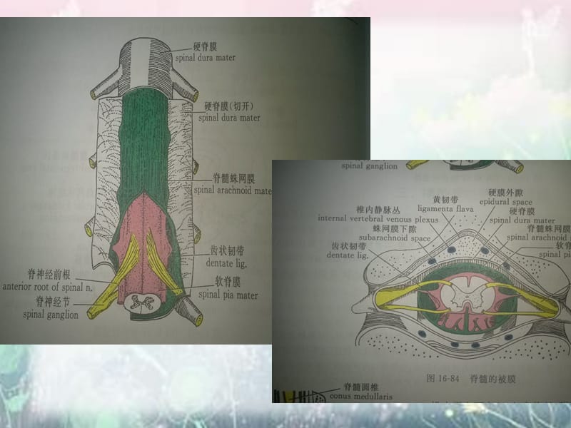 椎管内脊膜瘤的围手术期护理.ppt_第3页