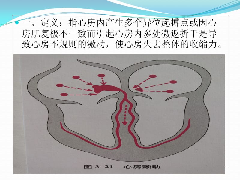 心房扑动(AF)心房纤颤(Af)临床与心电图.ppt_第2页