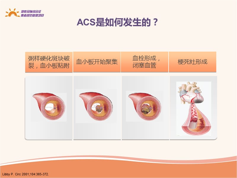 急性冠脉综合征患者治疗期健康教育.ppt_第3页