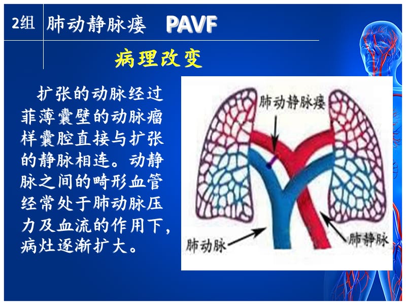 肺动静脉瘘.ppt_第3页