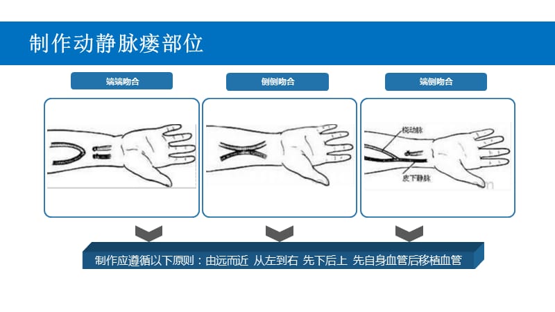 自体动静脉内瘘的护理常规.ppt_第3页