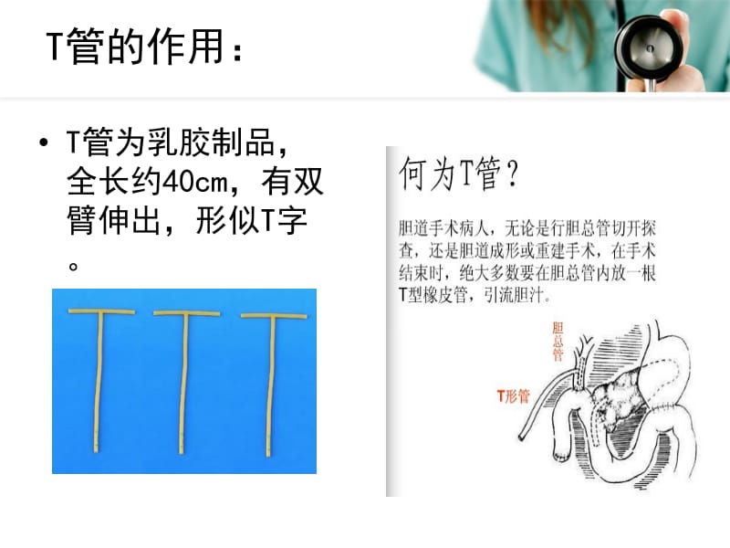 胆道术后T管的护理.ppt_第2页