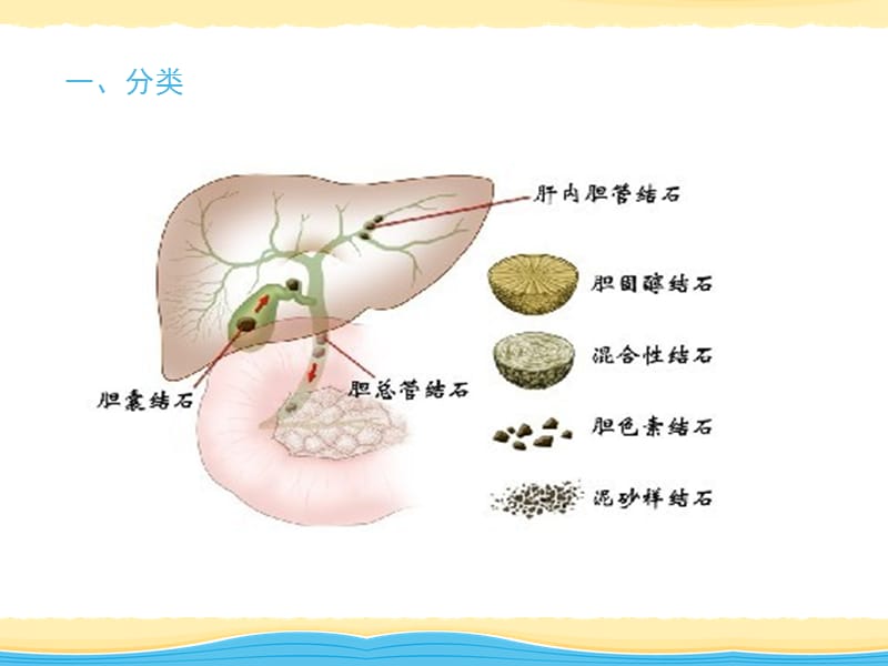 胆结石、慢性胰腺炎.ppt_第2页