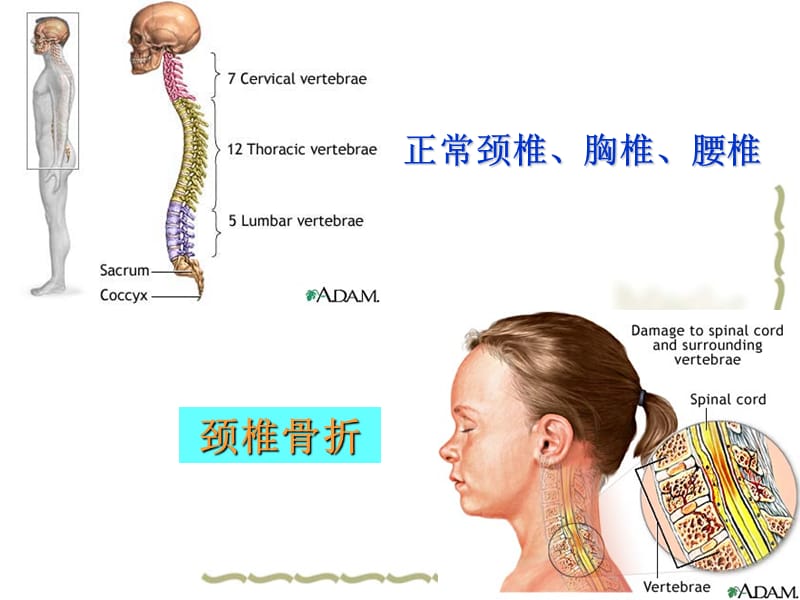 脊柱骨折与脊髓损伤病人的护理.ppt_第3页