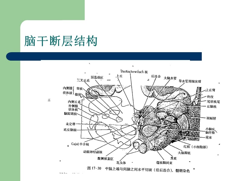 脑干血管病变常见综合征.ppt_第3页