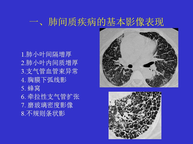 间质性肺疾病的CT诊断.ppt_第2页