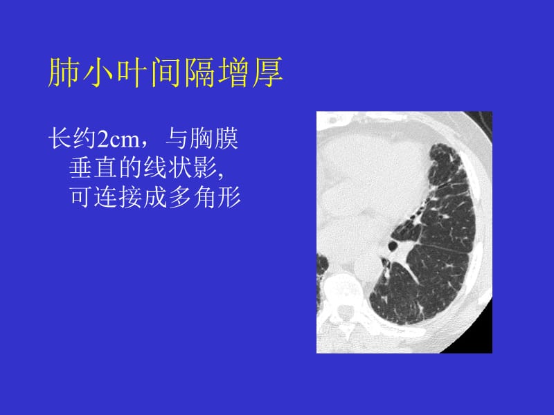 间质性肺疾病的CT诊断.ppt_第3页
