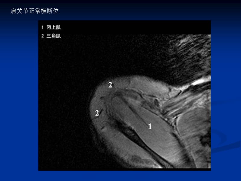 肩关节MR解剖.ppt_第2页