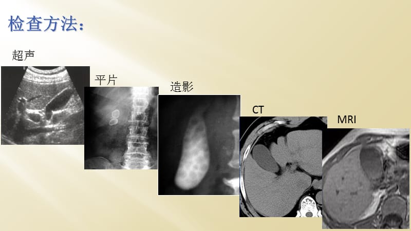 胆囊壁增厚性病变CT诊断与鉴别诊断.ppt_第3页