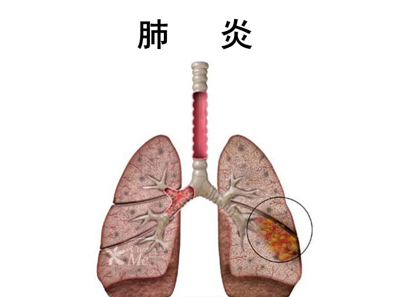 《肺炎护理》PPT课件.ppt_第1页