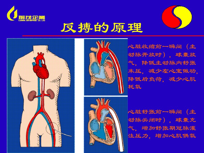 IABP原理及使用.ppt_第2页