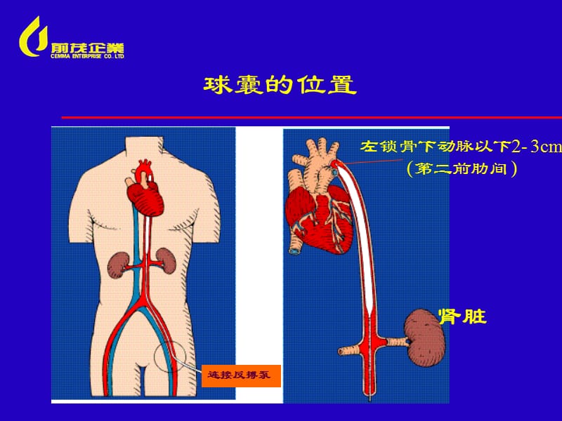 IABP原理及使用.ppt_第3页