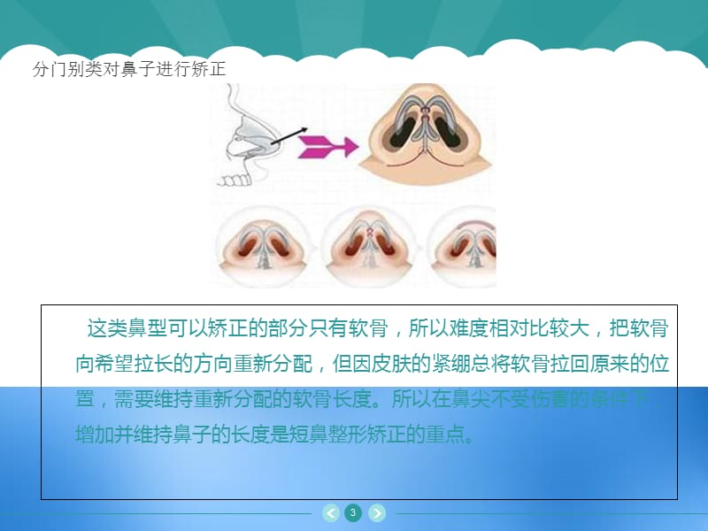 如何分门别类对鼻子进行矫正参考PPT.ppt_第3页