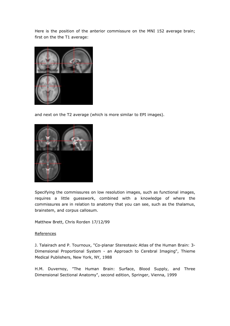 大脑前联合及后联合.doc_第3页