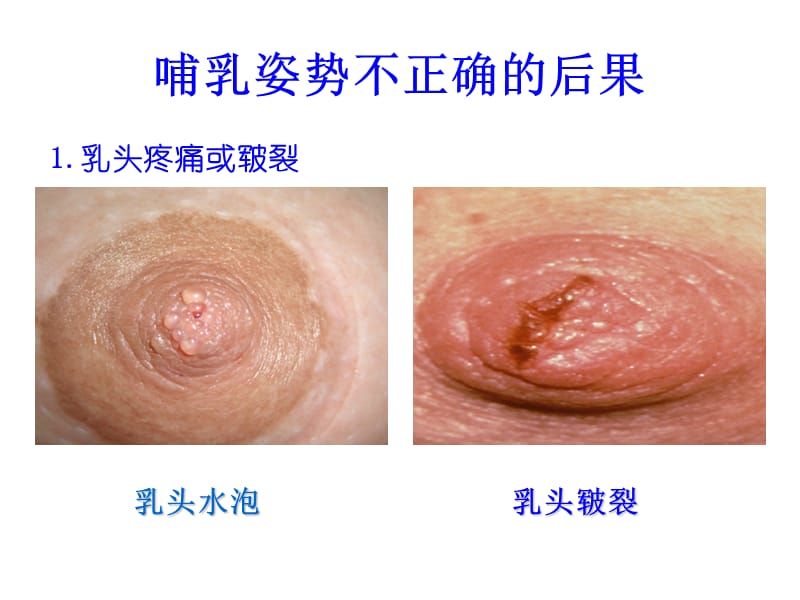 正确的哺乳姿势.ppt_第3页