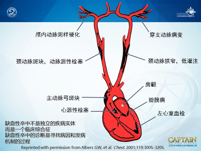 讲题5-缺血性卒中的病因和发病机制诊断.ppt_第2页