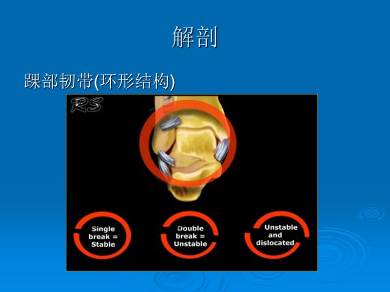 踝关节骨折Lauge-Hansen分型.ppt_第3页