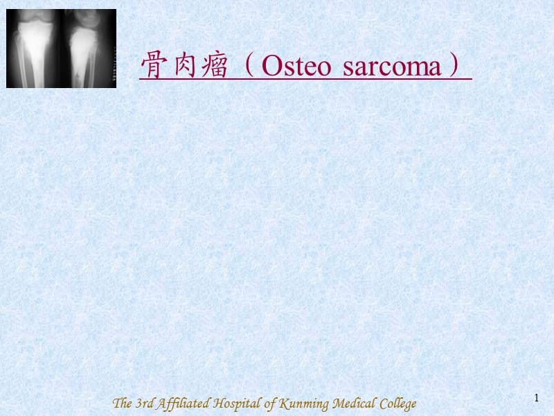 骨肉瘤(Osteosarcoma)-PPT课件.ppt_第1页