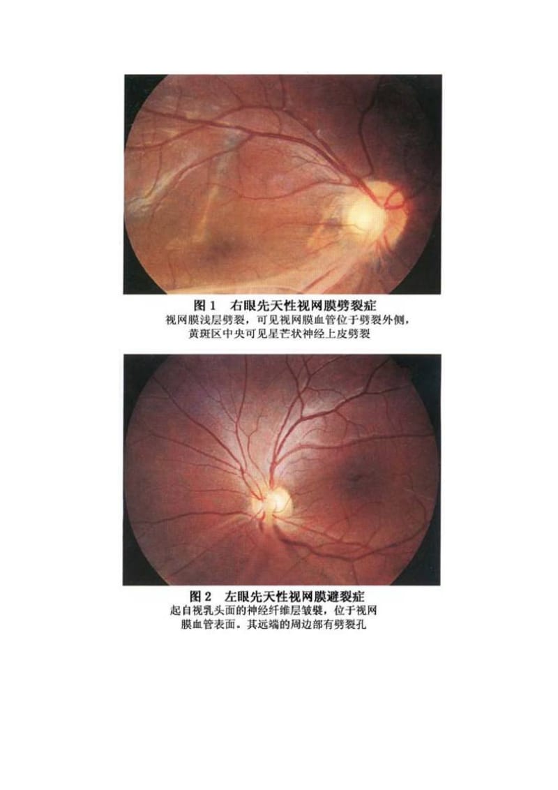 先天性视网膜劈裂症.doc_第3页