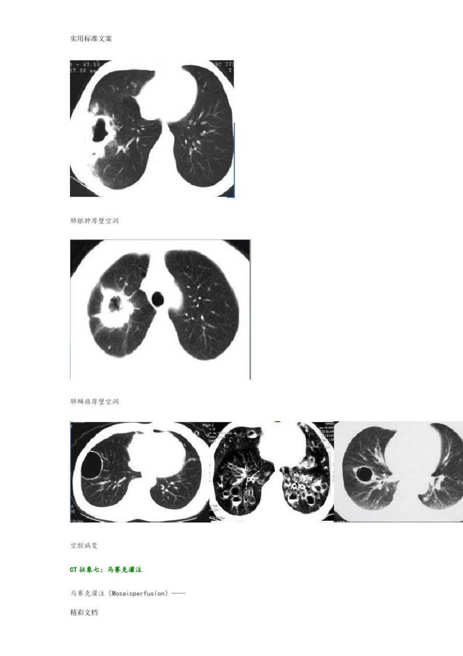 肺部CT十大征象.doc_第3页
