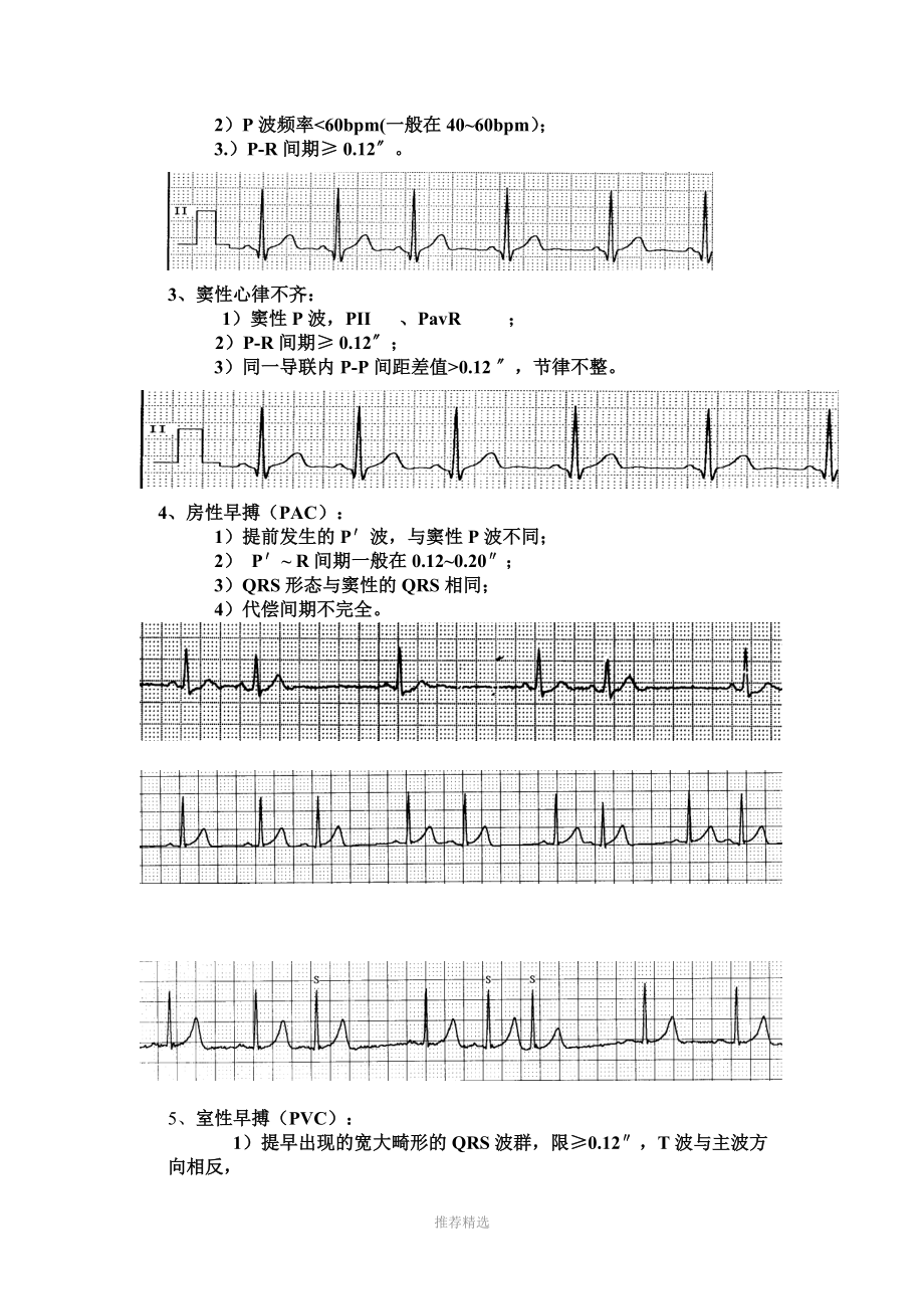 心电监护中常见的异常波形.doc_第2页