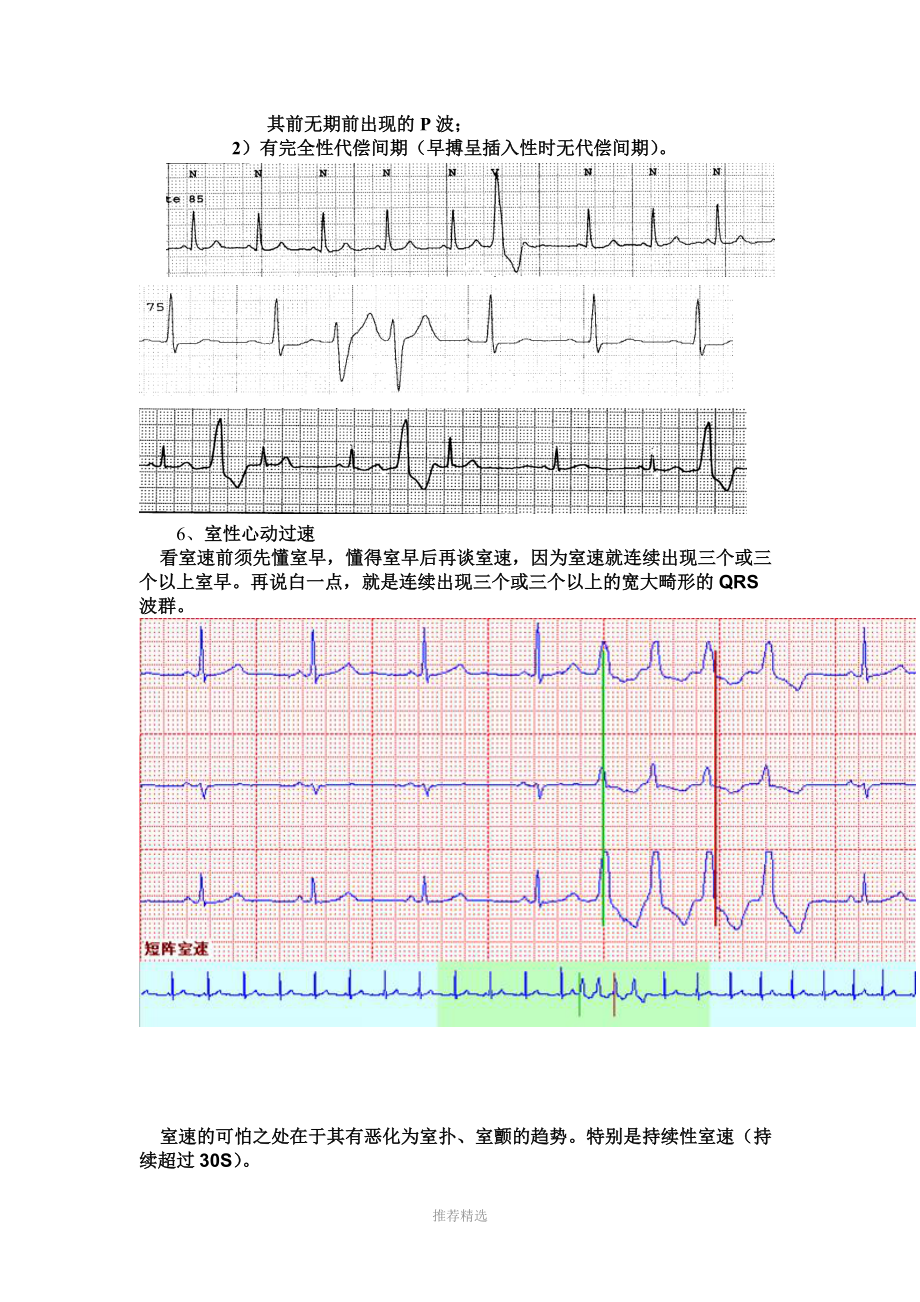 心电监护中常见的异常波形.doc_第3页