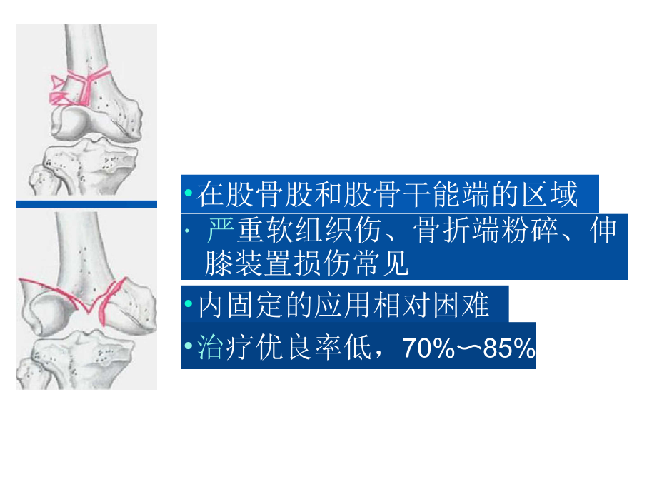 股骨远端骨折.docx_第2页