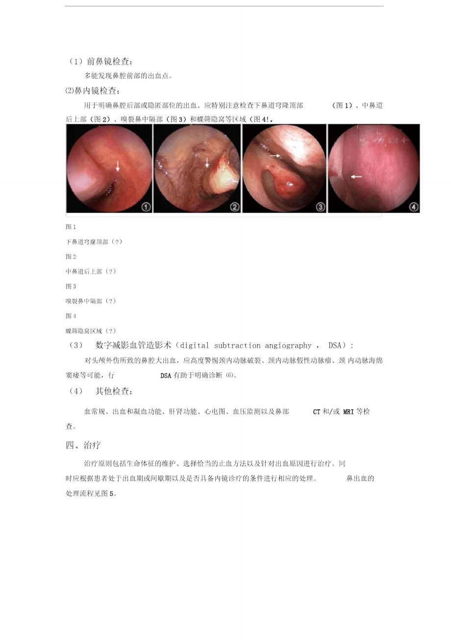 鼻出血诊断及治疗指南(草案).doc_第2页