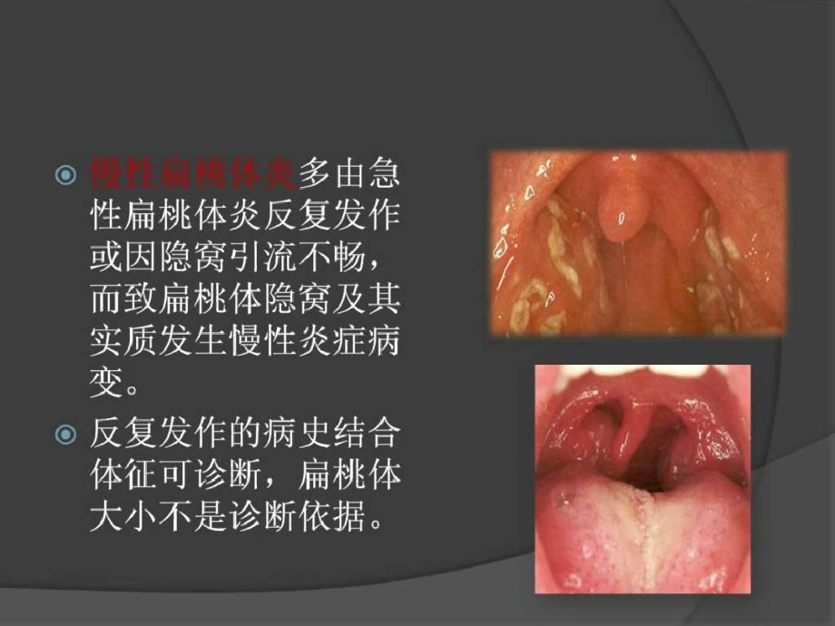 扁桃体切除对IgA肾病的影响.doc_第3页