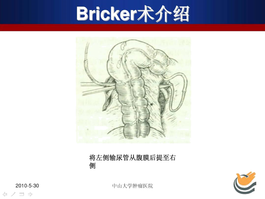 改良Bricker术介绍.doc_第3页