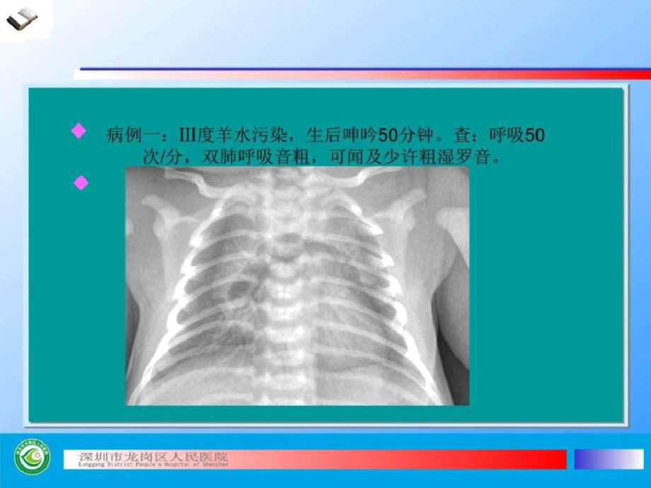 (结果版)新生儿胸片基本读片(共五例).docx_第2页