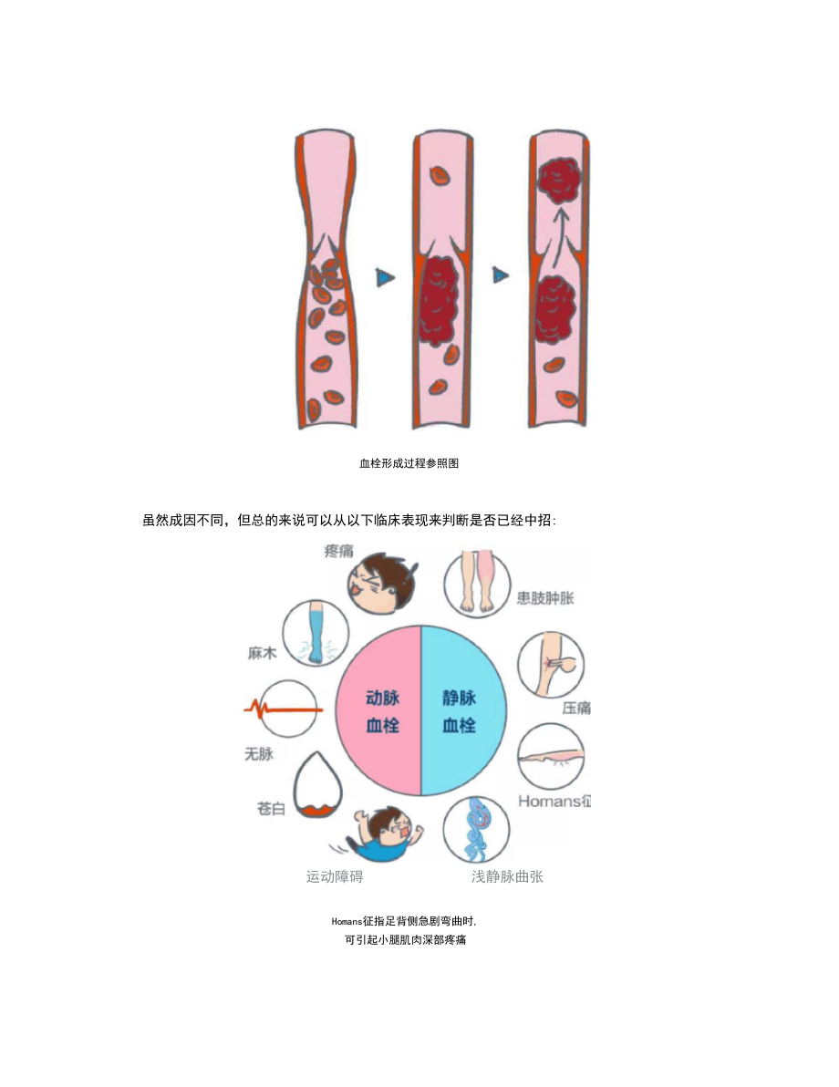 健康说：为啥你会有血栓？4招远离动静脉血栓,拿去不谢!.docx_第2页