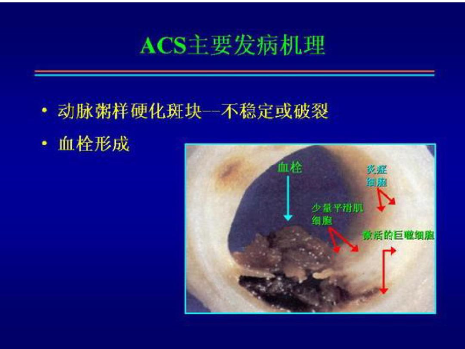 非ST段抬高急性冠脉综合征的治疗策略.docx_第2页