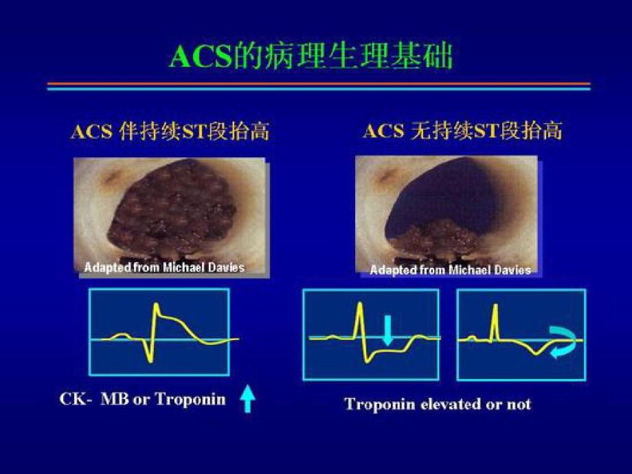 非ST段抬高急性冠脉综合征的治疗策略.docx_第3页