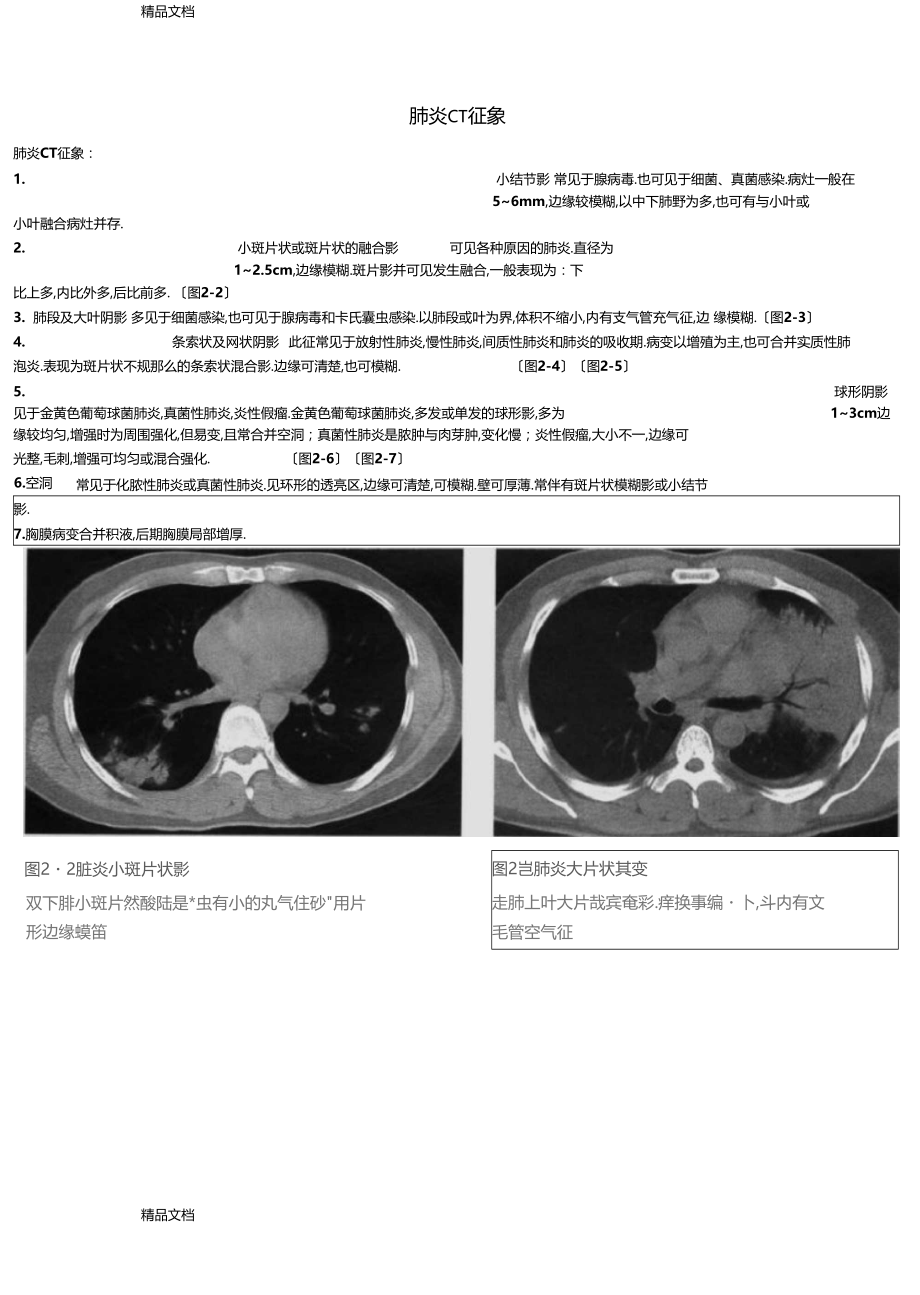 整理肺炎CT征象.docx_第1页