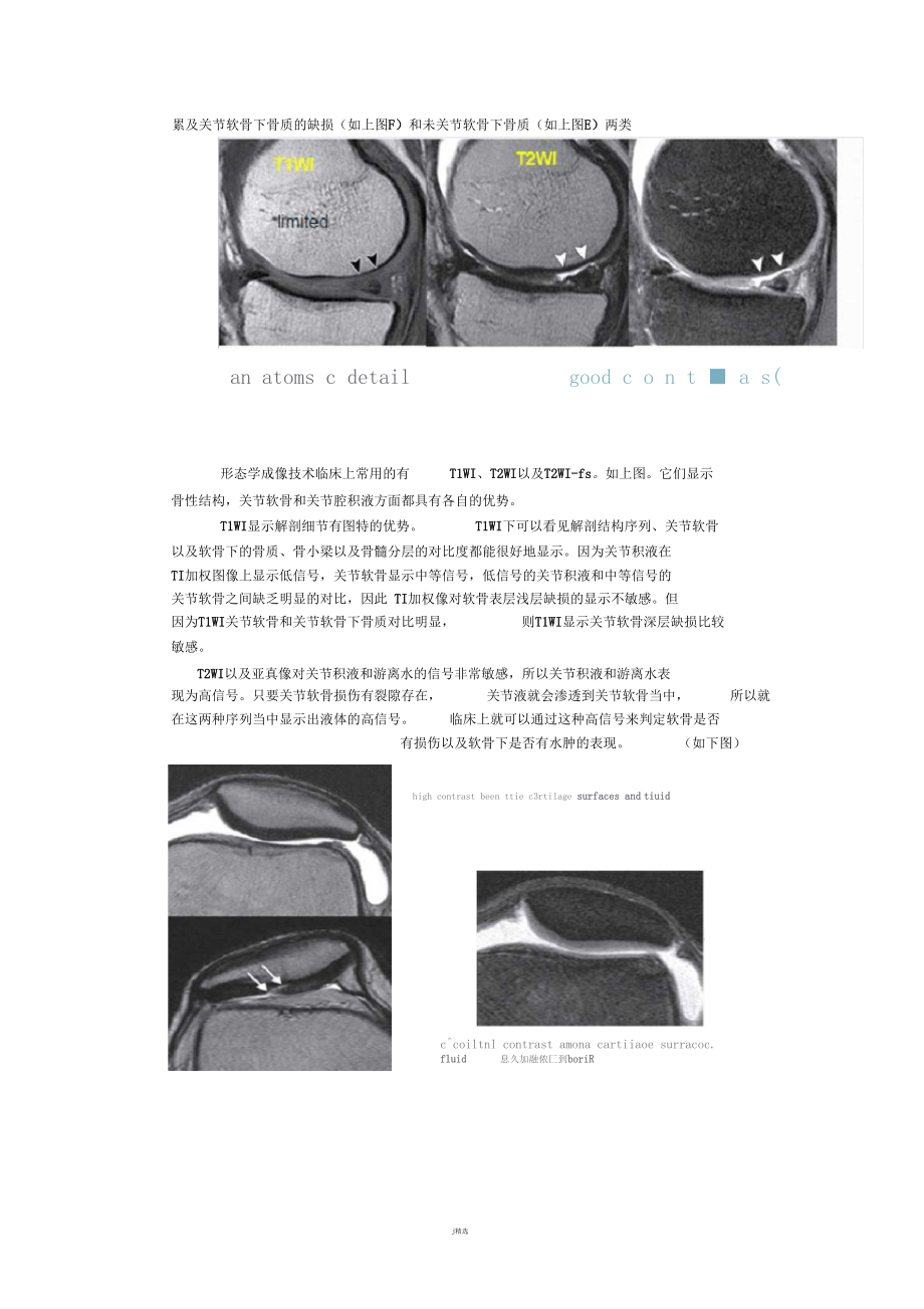 MRI对膝关节软骨损伤的诊断.docx_第2页