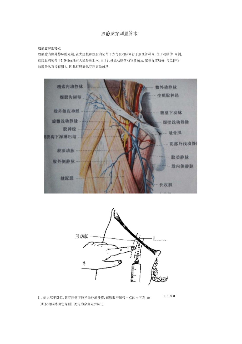 股静脉穿刺置管术.docx_第1页