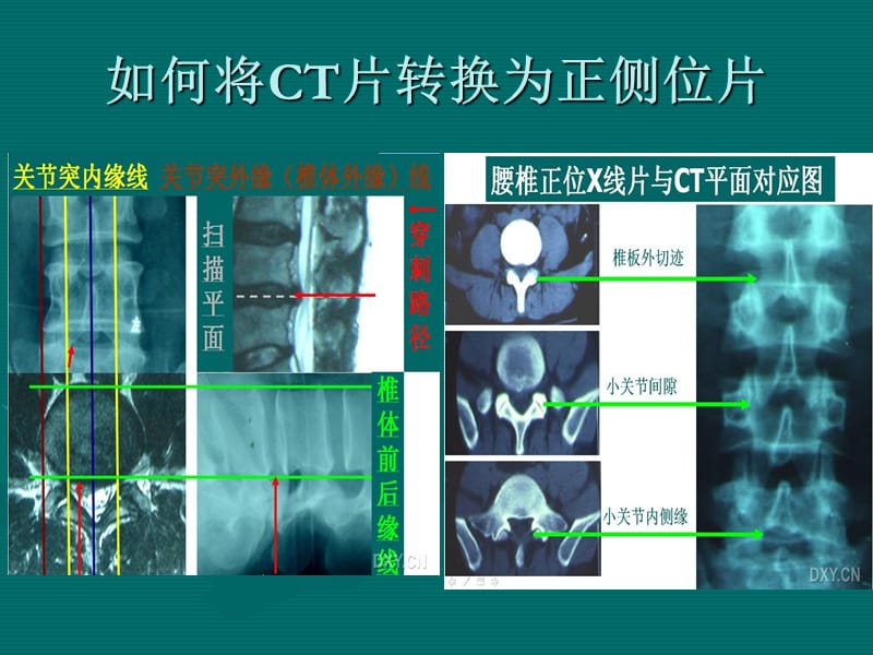 《射频穿刺技术》PPT课件.ppt_第3页