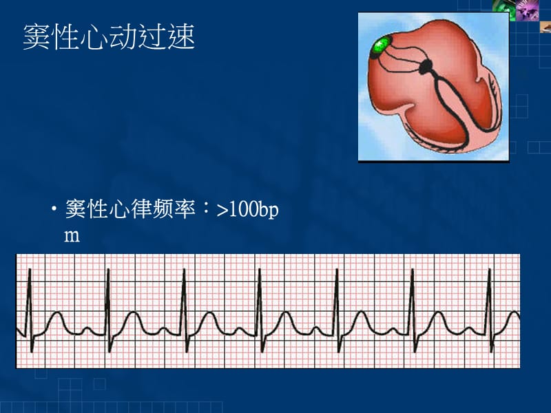 急救培训(心电图).ppt_第3页