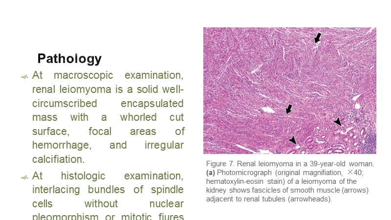 《肾平滑肌瘤》PPT课件.ppt_第3页
