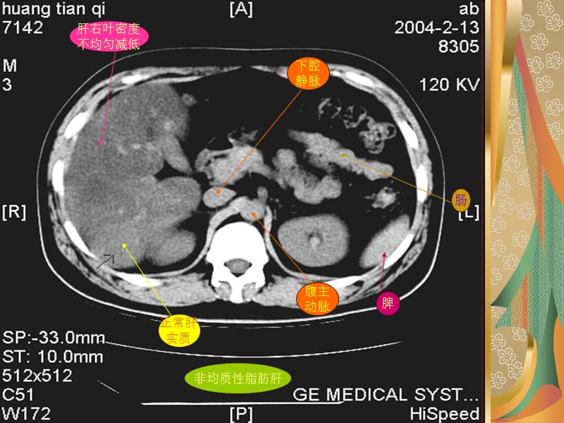 腹部CT0课件.ppt_第3页